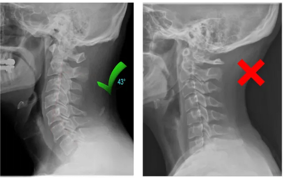 X-ray comparison: healthy cervical curve vs flattened neck from forward head posture